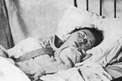 39_Londe-Hysterical-Sleep-La-photographie-medicale-1893.